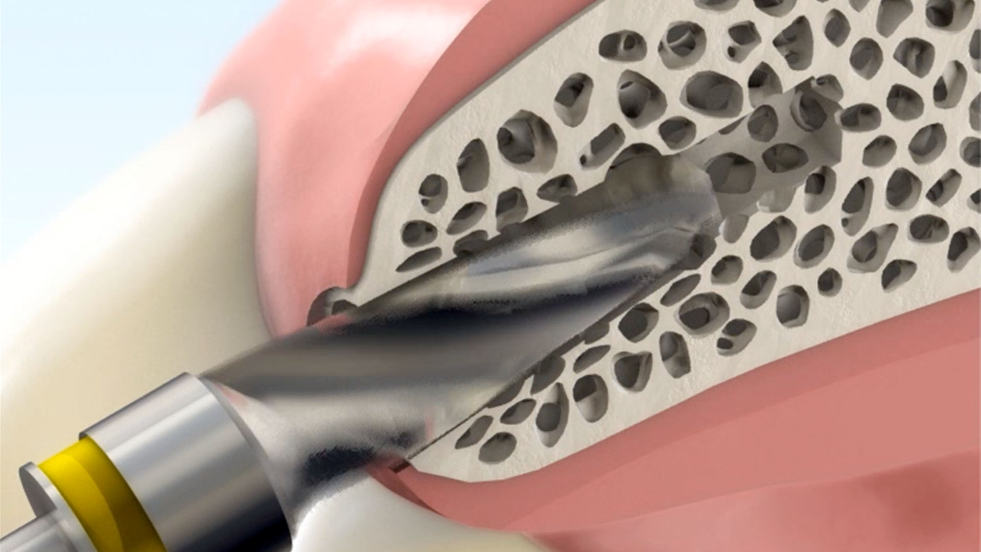 Dental implant Marketing 3D Video Production