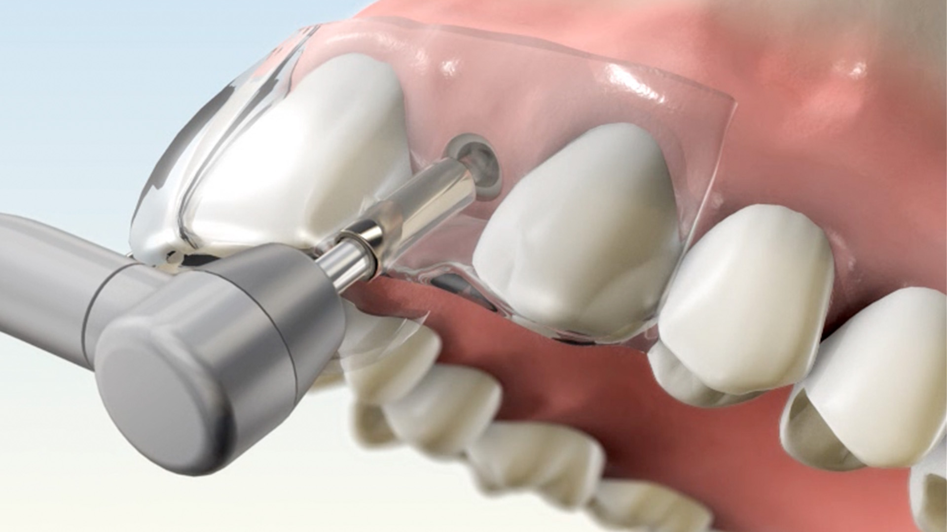 Dental implant Marketing 3D Video Production